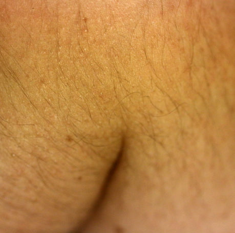 Elbow butt crack