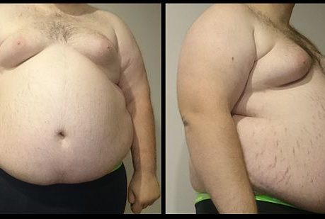 obesity obese man